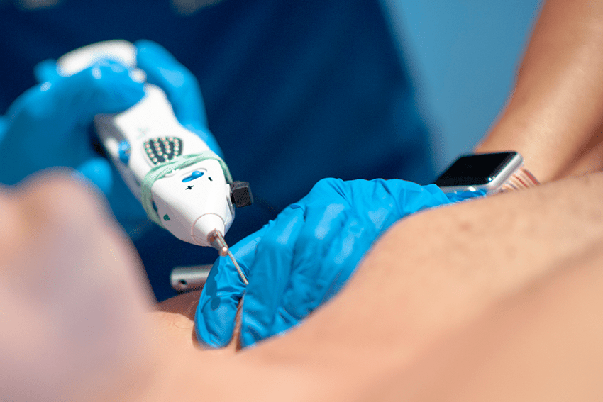 Why Does Adding Electricity to Dry Needling Make It More Effective? -  Western Slope Rehab & Performance